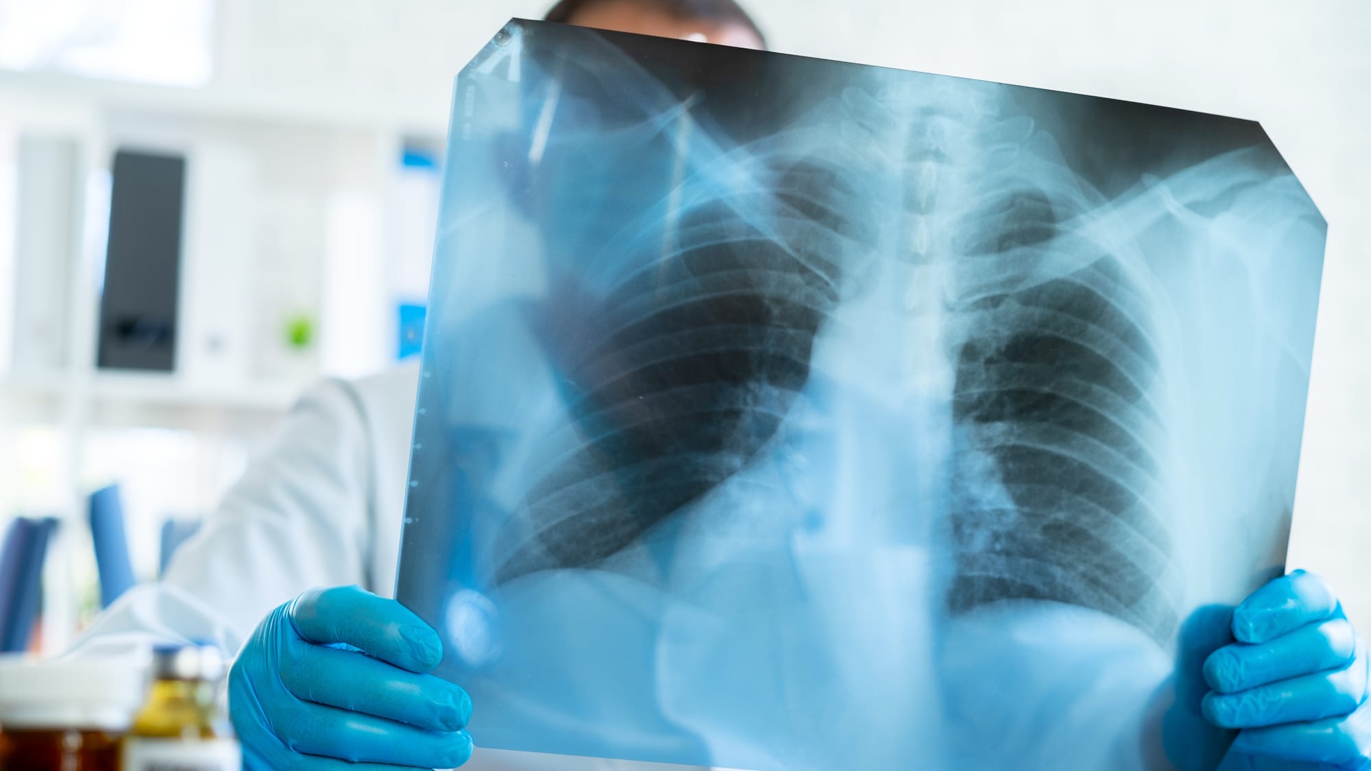 TB Screening at Mponeng Mine Draws Focus